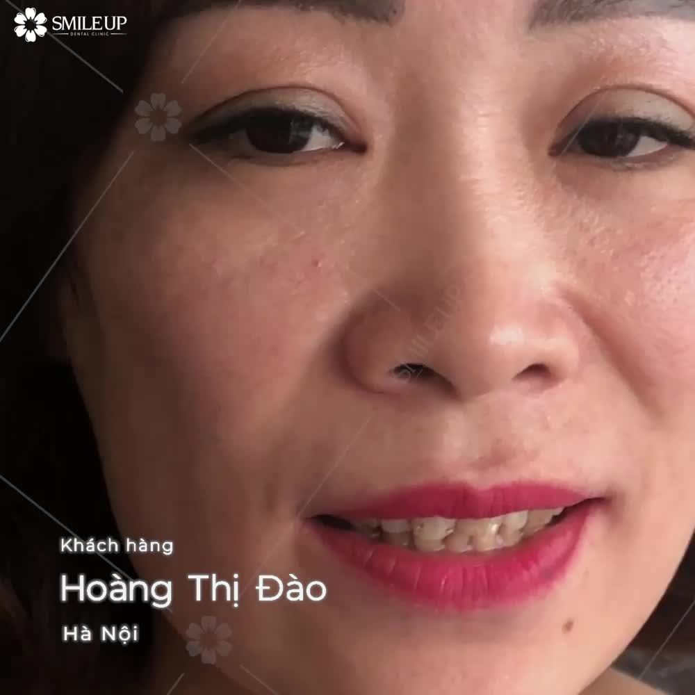 CASE 4080: RĂNG Ố VÀNG, SỨT MẺ, HÌNH THỂ XẤU