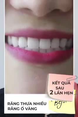 DẸP BỎ HÀM RĂNG THƯA, Ố VÀNG CHỈ SAU 2 LẦN HẸN