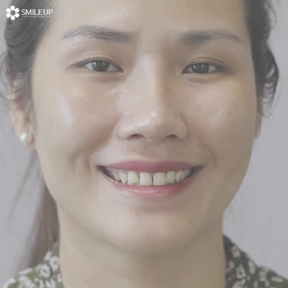 CASE 4082: RĂNG THƯA NHIỀU, Ố VÀNG.