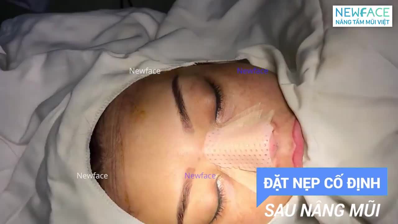 TÁC DỤNG CỦA NẸP ĐỊNH HÌNH SAU NÂNG MŨI