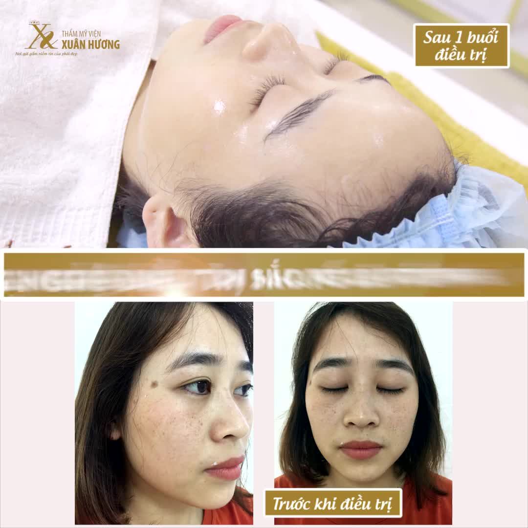 TÀN NHANG SẼ HẾT SẠCH CHỈ 1 LẦN DUY NHẤT, NẾU BẠN CHỌN ĐÚNG CÔNG NGHỆ NÀY...