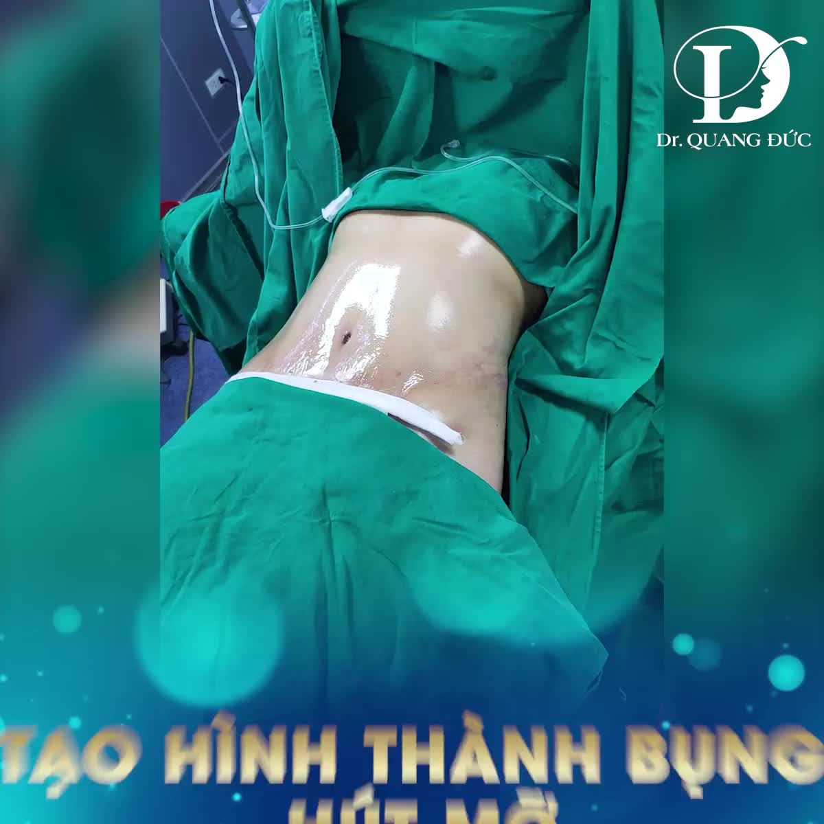 Chỉ 55TR cho combo Tạo hình thành bụng+hút mỡ- TẶNG thêm 9TR