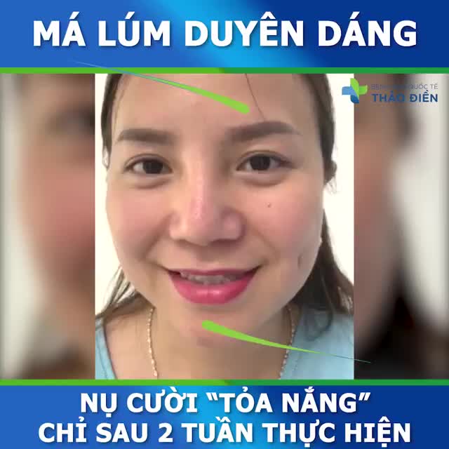 NỤ CƯỜI TỎA NẮNG TRẮNG XÓA MÀN HÌNH SAU 2 TUẦN TẠO_MÁ_LÚM