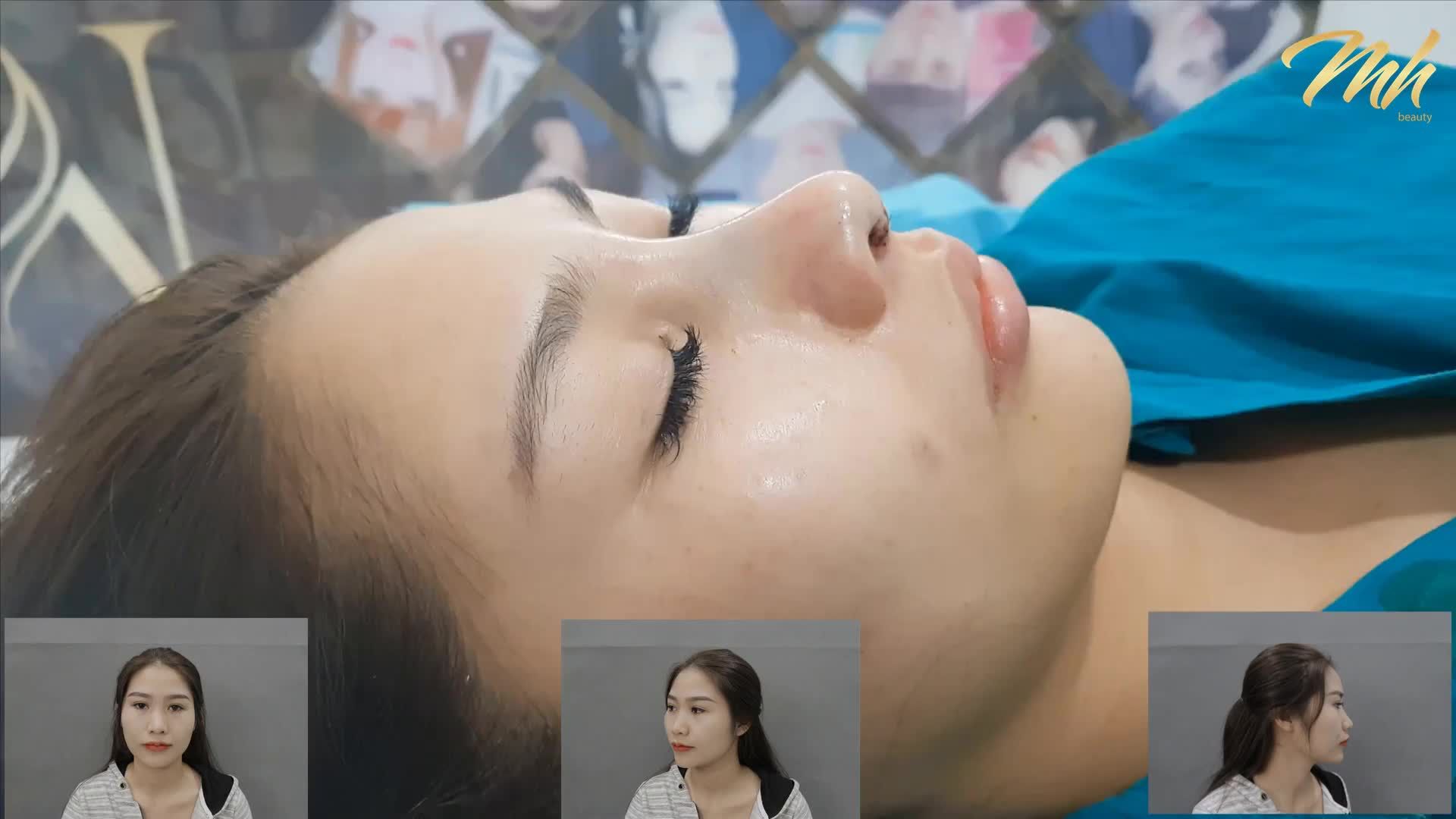 THAY ĐỔI NGAY SAU KHI NÂNG MŨI