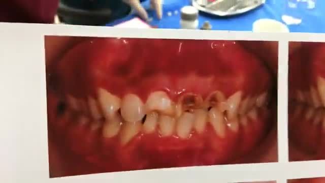 Livestream lắp răng sứ, tổn thương nghiêm trọng cho bạn Hưng tại Nha Khoa Thùy Anh.