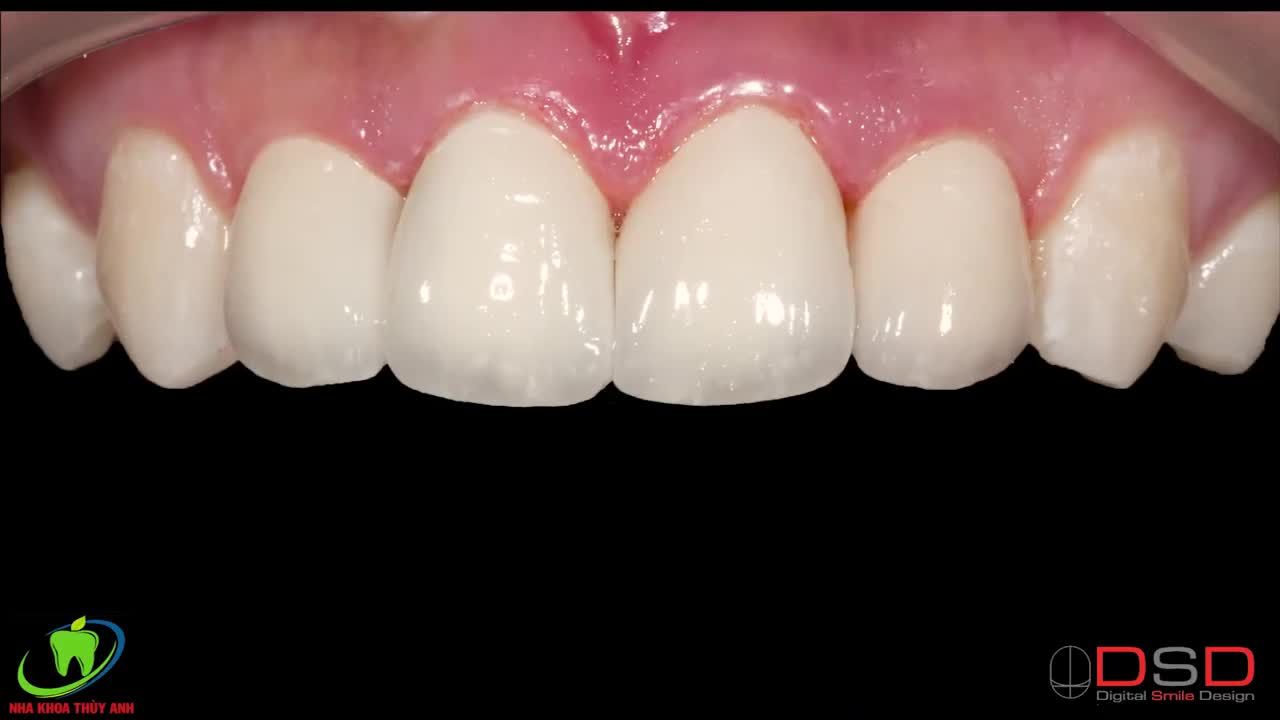 LỢI ÍCH KHÔNG NGỜ KHI BỌC RĂNG SỨ TẠI NHA KHOA THÙY ANH