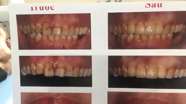 Trực tiếp lắp răng thẩm mỹ tại Nha Khoa Thùy Anh.