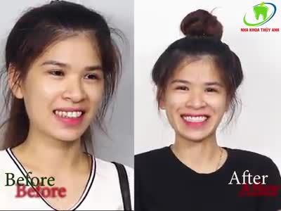 BỌC RĂNG SỨ - THÊM TỰ TIN 
CHẤT LƯỢNG AN TOÀN - ĐỘ BỀN ĐẢM BẢO