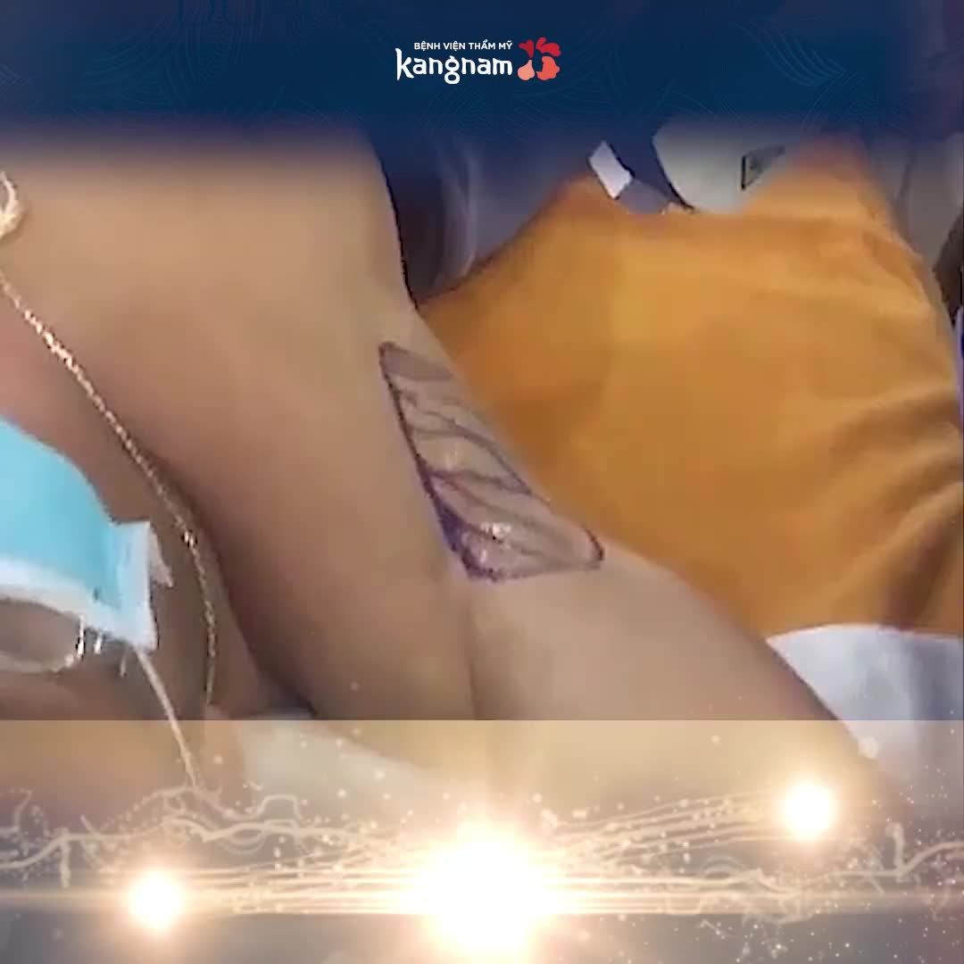 Hết hôi vĩnh viễn nhờ Endo Dry