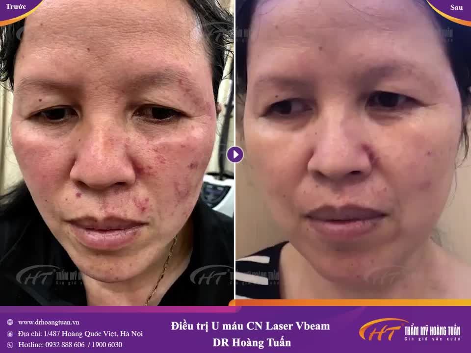 Tuyệt vời! Kết quả trị u máu với Vbeam tại Dr Hoàng Tuấn!