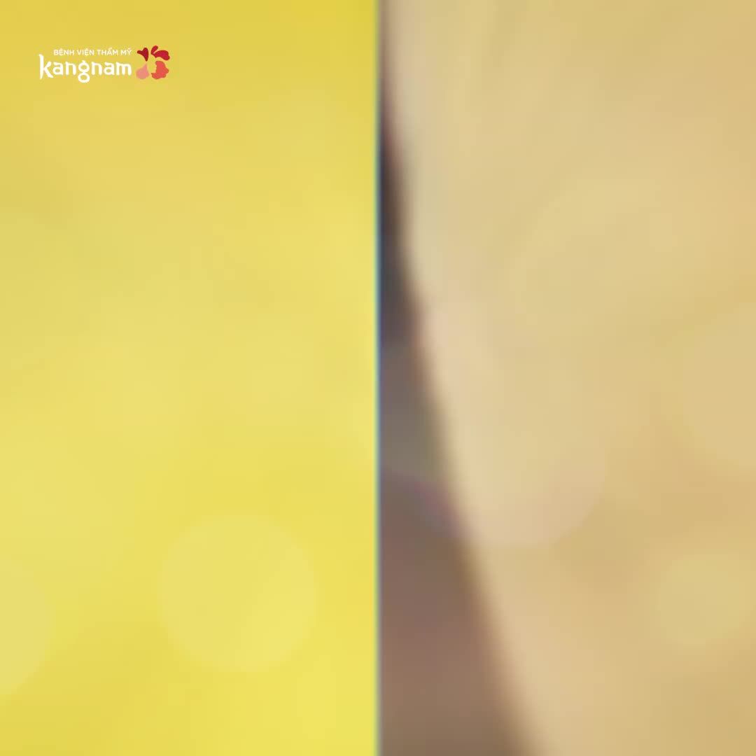 Triệt lông tận gốc - Giá sốc tuần vàng