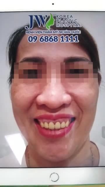 "VẼ LẠI NỤ CƯỜI" CHO U50 CƯỜI HỞ LỢI