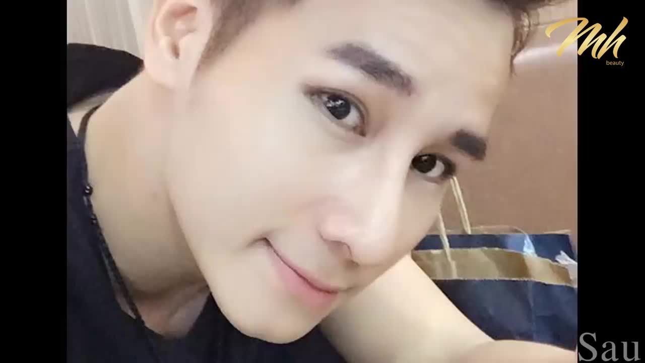 VÉN BỨC MÀN PHƯƠNG PHÁP NÂNG MŨI CẤU TRÚC