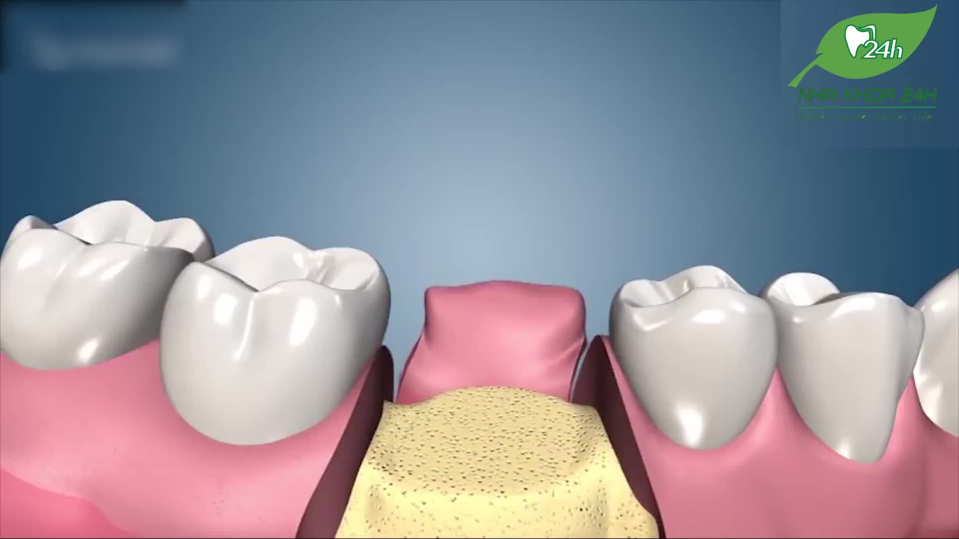 Bằng việc khôi phục lại một chiếc răng mới