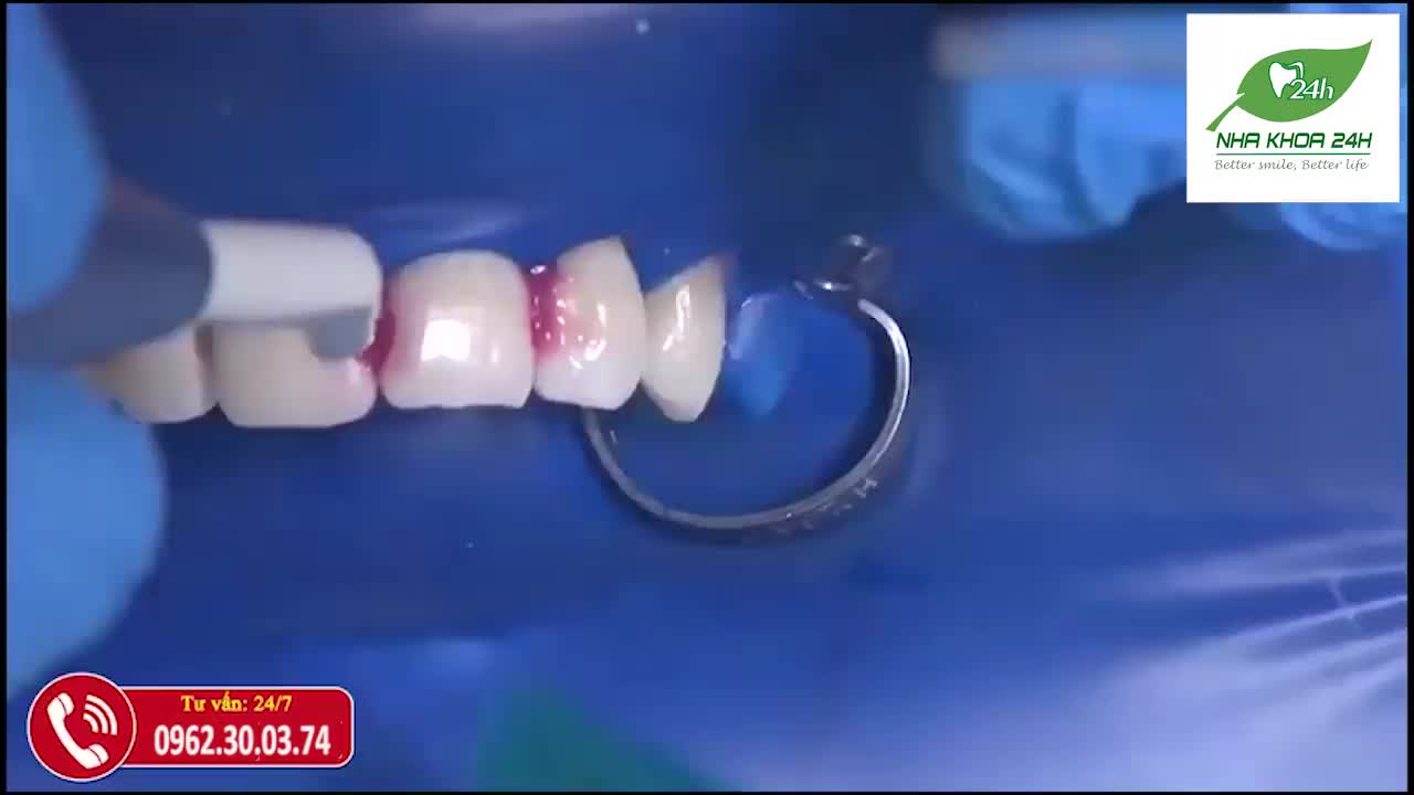 Vật liệu composite có khá nhiều ưu điểm như