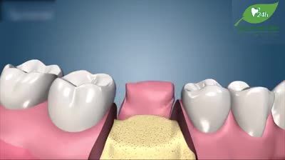 NGUY HIỂM] HẬU QUẢ DO MẤT RĂNG LÂU NGÀY