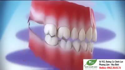 MẤT RĂNG SỐ 6 NGUY HIỂM HƠN TA NGHĨ