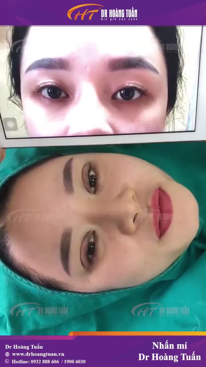Hai mí sắc nét hơn, to đều hơn ngay sau nhấn mí 5 điểm Dr Hoàng Tuấn!