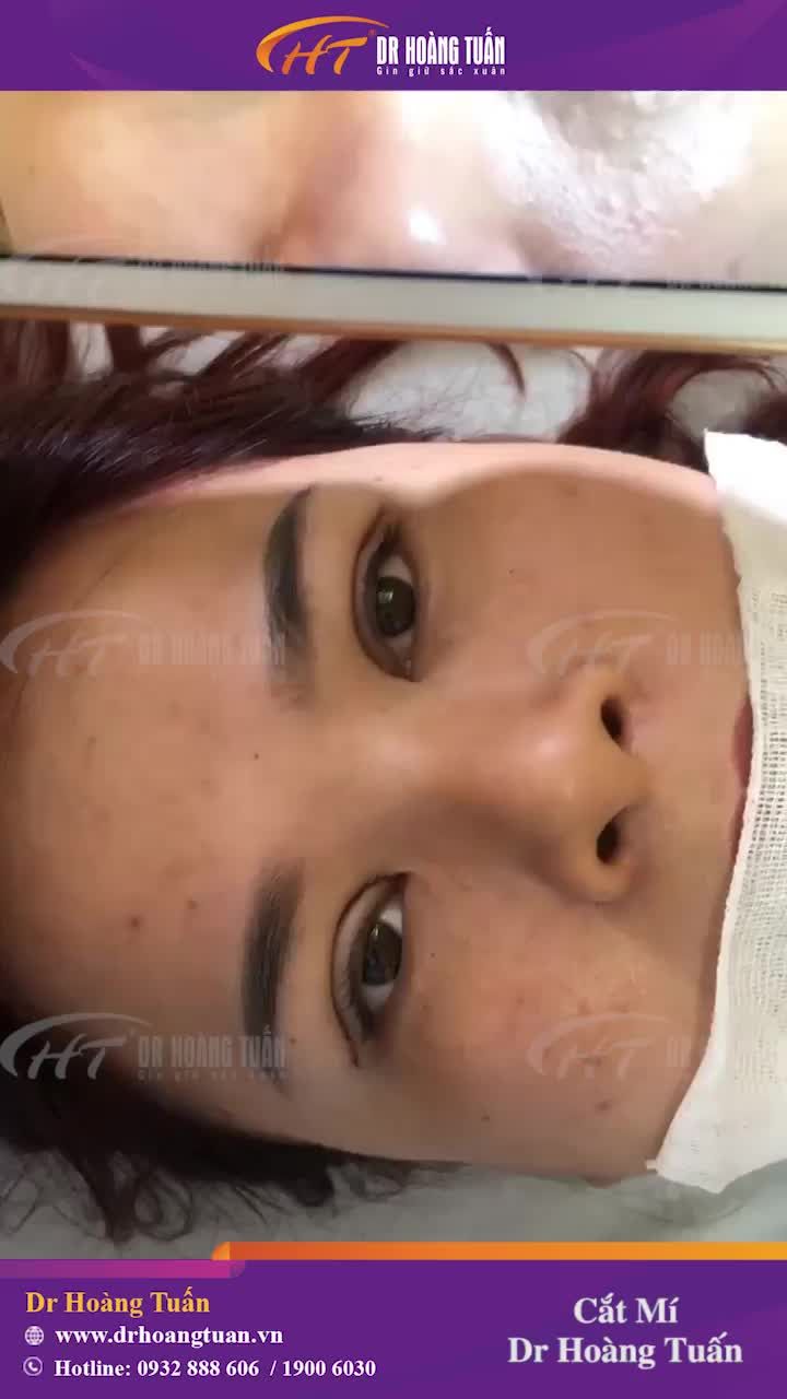 Case mí số 55 trong tháng 8 của Dr Hoàng Tuấn đây ạ!