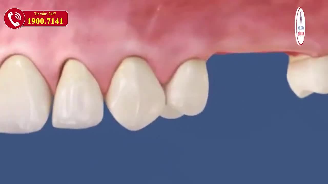 Răng hàm có chức năng quan trọng trong việc ăn nhai của cả hàm