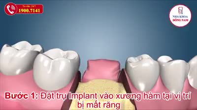 Trồng răng Implant đang là sự lựa chọn trồng răng giả hàng đầu cho những người bị mất răng bằng cách cấy ghép một trụ chân răng giả bằng titanium để thay thế cho chân răng đã bị mất.