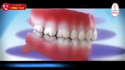 Trồng răng Implant được xem là một giải pháp cấy ghép răng giả hoàn hảo nhất hiện nay, phù hợp với nhiều trường hợp mất răng khác nhau.
