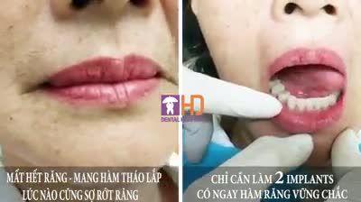 Đối với người cao tuổi mang hàm tháo lắp, thì việc hàm bị xục xịch khi ăn nhai hoặc nói chuyện gây ra sự khó chịu