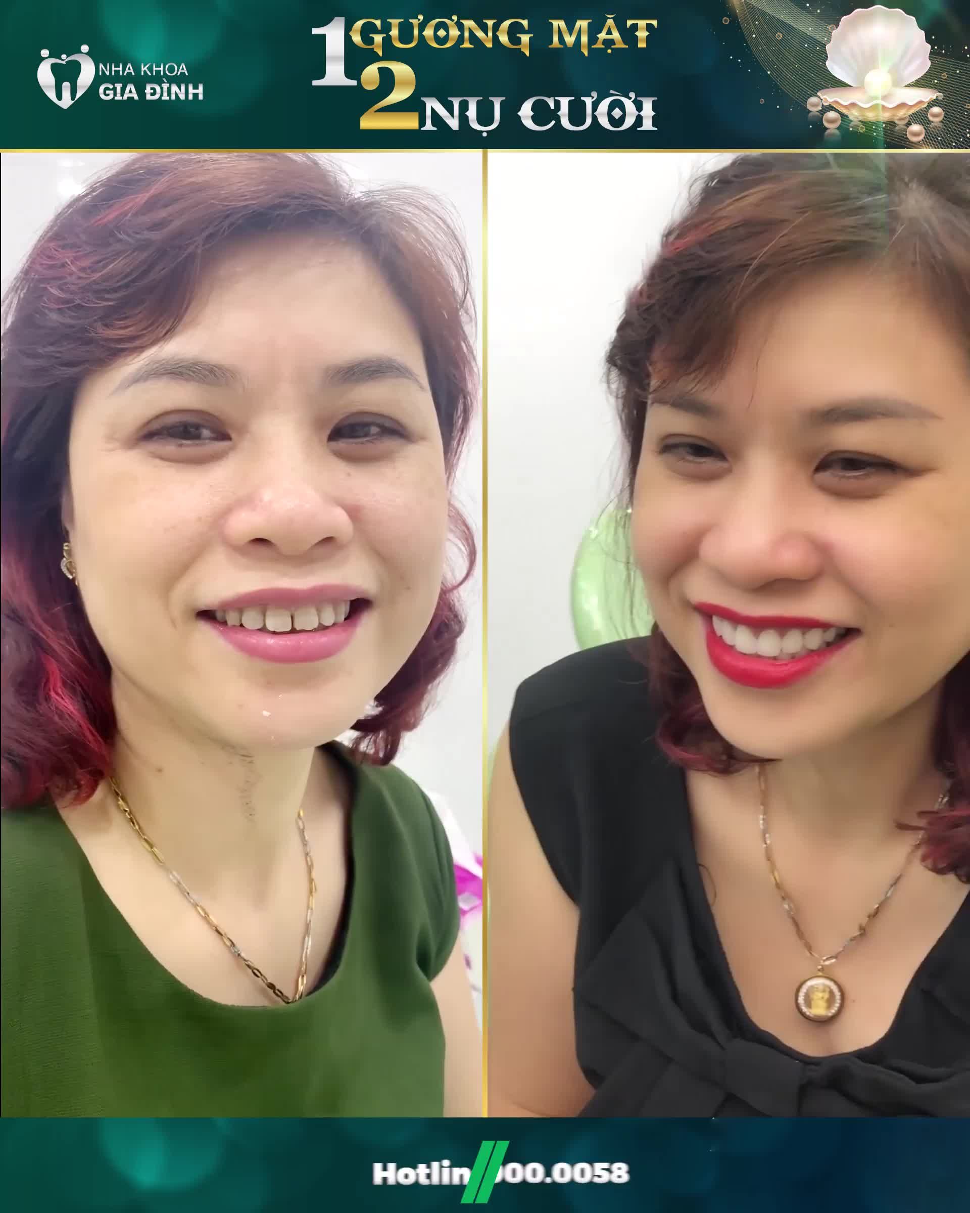 MỘT GƯƠNG MẶT HAI NỤ CƯỜI]
THẨM MỸ RĂNG CHỈ TỪ 2TR/RĂNG