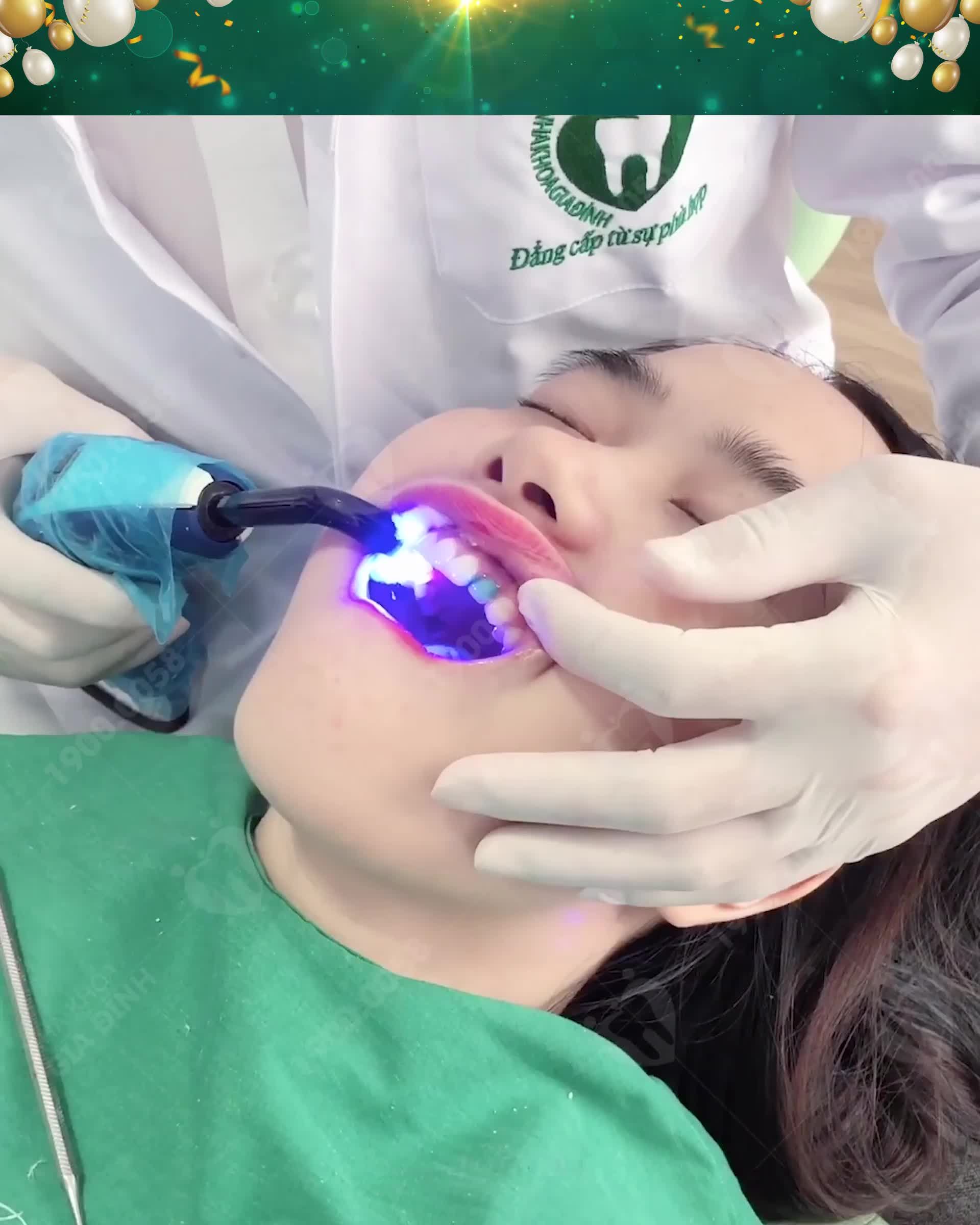 CẬN CẢNH QUÁ TRÌNH DÁN SỨ VENEER TẠI NHA KHOA GIA ĐÌNH