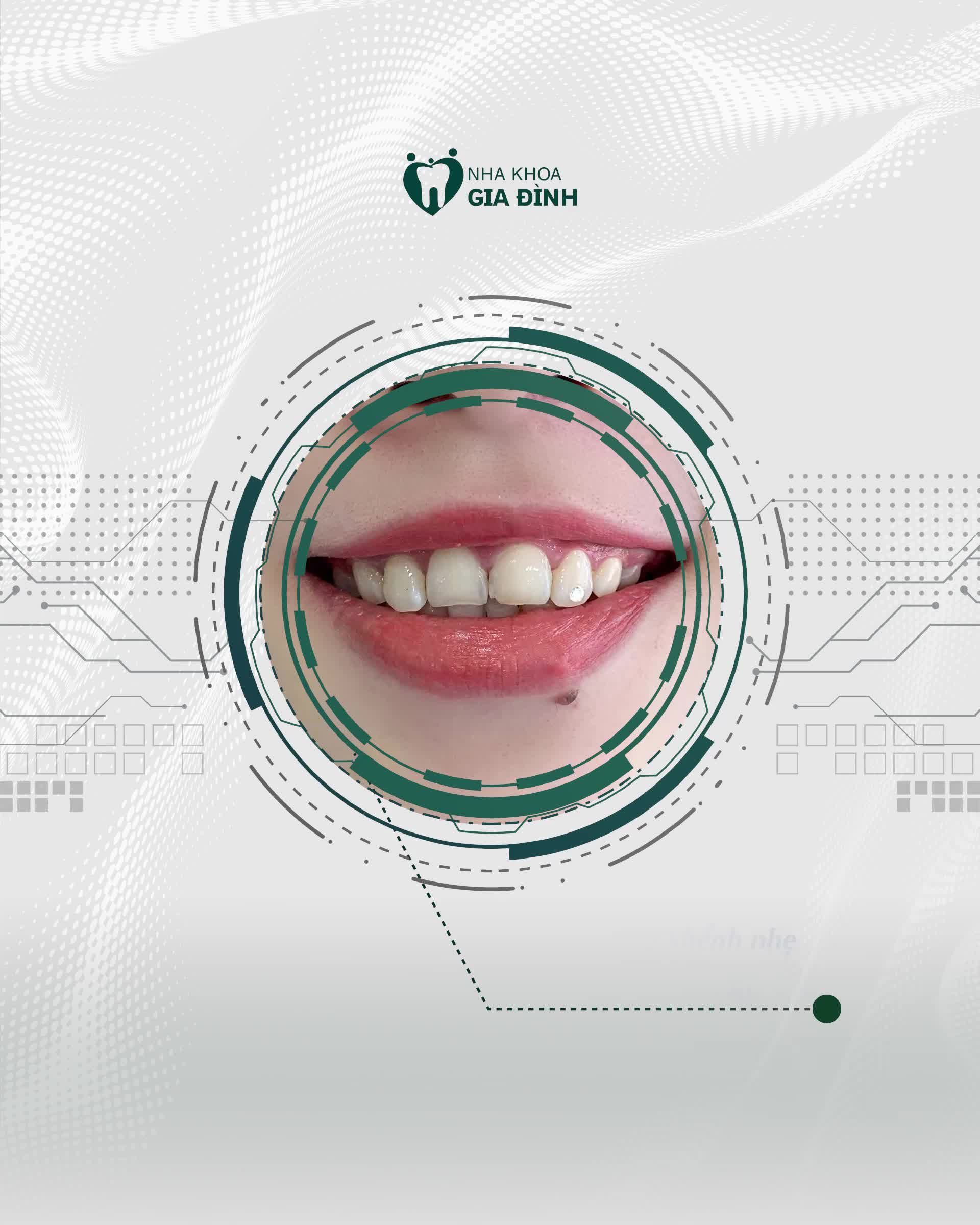 CƯỜI DUYÊN ĐÁNG TIỀN CHỈ TỪ 2TR/RĂNG