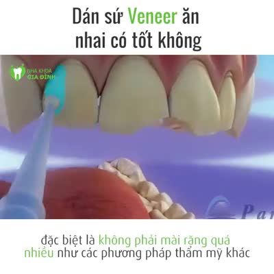 DÁN SỨ VENEER ĂN NHAI CÓ TỐT KHÔNG