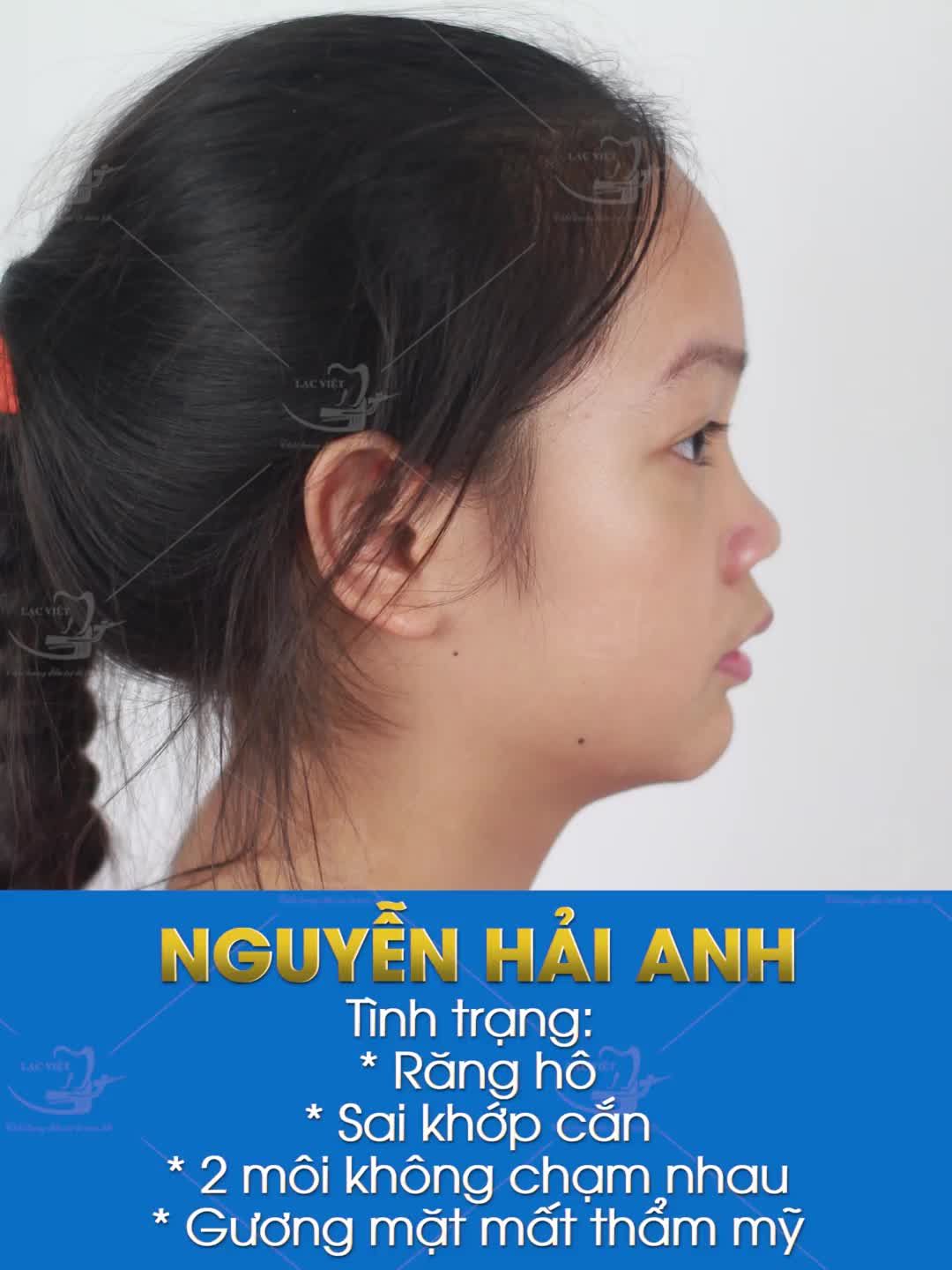 NIỀNG RĂNG CHO CON CÀNG SỚM – ĐẸP CÀNG NHANH