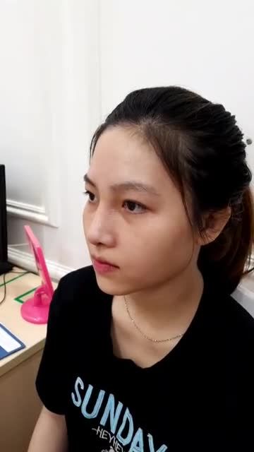 Khách hàng nâng mũi Sline 4D siêu âm