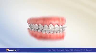 ĐEO HÀM DUY TRÌ SAU NIỀNG RĂNG CÓ CẦN THIẾT KHÔNG