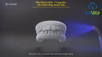 Chỉnh nha không mắc cài INVISALIGN