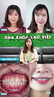 Hình ảnh mới nhất của bạn Minh Hà (24 tuổi) sau 6 tháng niềng răng khấp khểnh tại NK Lạc Việt.