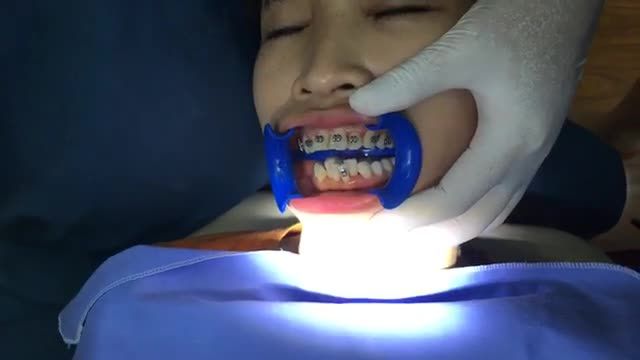 Trực tiếp gắn mắc cài hàm dưới cho chị Huyền tại Nha Khoa Thùy Anh.