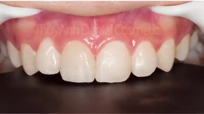 Áp dụng các công nghệ tiên tiến nhất vào quá trình điều trị thẩm mỹ răng cửa duy nhất tại Thái Nguyên - Nha Khoa Thùy Anh.