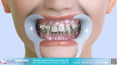 NIỀNG RĂNG LÀ KHÔNG CHỜ ĐỢI