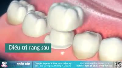 NỤ CƯỜI XINH BẮT ĐẦU TỪ CHÍNH HÀM RĂNG ĐẸP