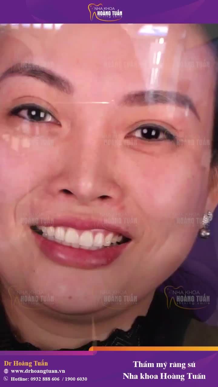 Ưu đãi răng sứ thẩm mỹ