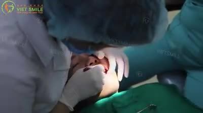 QUÁ TRÌNH GẮN MẮC CÀI KIM LOẠI THƯỜNG