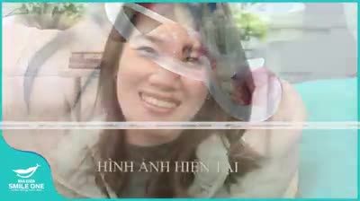 ƯU ĐÃI ĐẶC BIỆT: NIỀNG RĂNG MẮC CÀI CHỈ TỪ 16 TRIỆU 2 HÀM