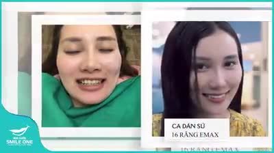 ĐÃ TỪNG NIỀNG RĂNG VÀ BỊ HỎNG THÌ PHẢI LÀM SAO?