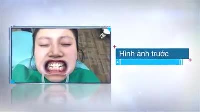 Veneer chính là lớp sứ mỏng được ví như sơn móng tay được dán bên ngoài răng của bạn bằng một loại keo đặc biệt