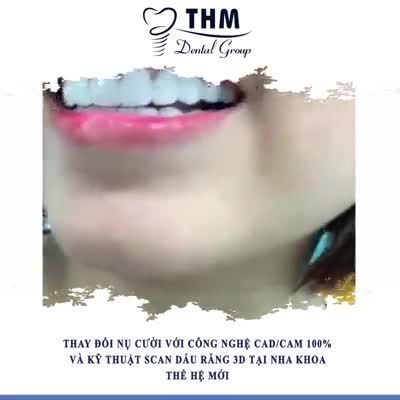 GIẢI PHÁP BỌC RĂNG SỨ CHO NGƯỜI BẬN RỘN