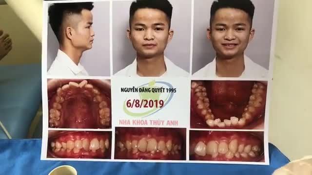 MỜI CÁC BẠN XEM LIVESTREAM CỦA NHA KHOA THÙY ANH NHÉ.