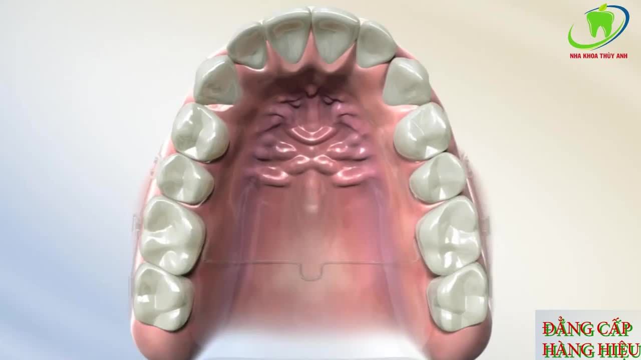 KÉO DÀN ĐỀU RĂNG BẰNG KHÍ CỤ TRONG CHỈNH NHA NHƯ NÀY NHÉ.