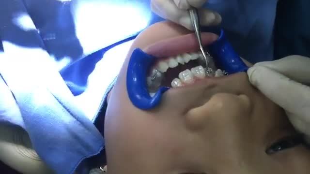 Trực tiếp gắn mắc cài cho bạn Vũ Bích Hồng điều trị khớp cắn ngược, răng lệch lạc tại Nha Khoa Thuỳ Anh