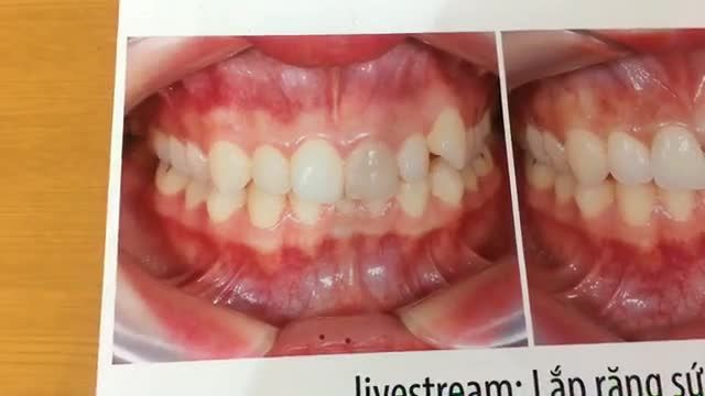 Trực tiếp gắn 4 răng sứ ceramill cho chị Trang .
Bá sĩ thực hiện: Dr. Mai Chí Đạt.